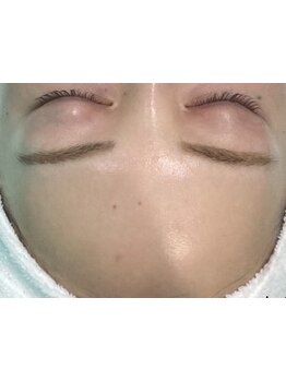 顔脱毛がしたい