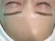 エーケーエステティックス 熊本新市街店(AK Esthetics)の写真/つるんとツヤ肌GETには顔脱毛☆【フェイシャルワックス¥7700】皮脂の詰まりを解消しでトーンアップも叶う♪