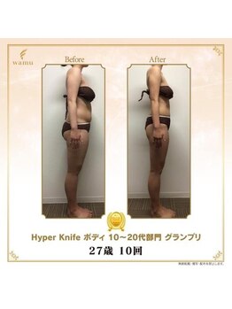 ウィクシム(Wixim)/ハイパーナイフBefore,After