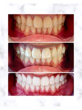 エスビーワイビューティー(SBY Beauty)/（45分）セルフホワイトニング！