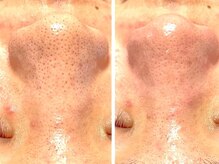 香嬉琉/学割・UR24 初めての毛穴ケア