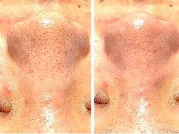 香嬉琉/学割・UR24 初めての毛穴ケア