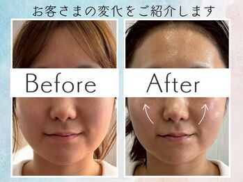 さくら鍼灸院 整骨院/美容鍼1