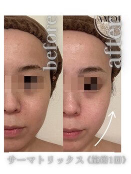 アムールドゥ 麻布十番(Amour deux)/サーマトリックスでリフトアップ