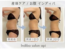 アピ(api)/症例写真【産後インディバ】