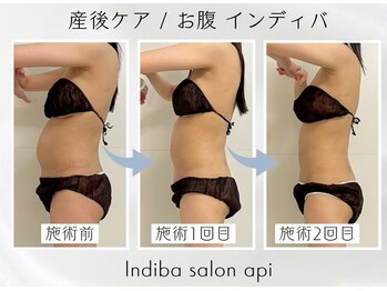 アピ(api)/症例写真【産後インディバ】