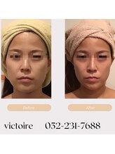 ヴィクトワール(Victoire)/小顔になりたい方はvictoireへ