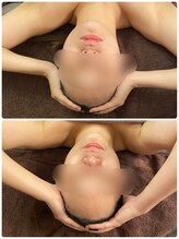 森の時計/症例写真:小顔編