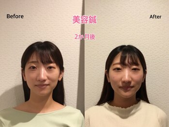 チキバン美容鍼灸整体サロン 心斎橋店/美容鍼（美容針）の経過2