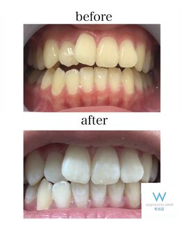 ホワイトニングショップ 町田店/【ビフォーアフター】1回