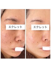 エクレット/最新光フェイシャル