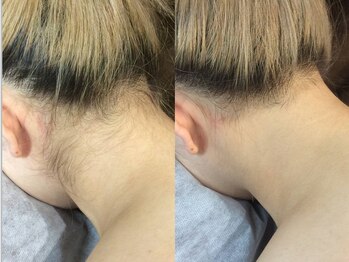 脱毛サロン ベル(Bell)/【レディース脱毛】