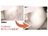 【毛穴・ニキビ改善に特化】肌診断ピーリング&毛穴洗浄&ビタミンC導入