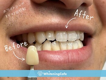 ホワイトニングカフェ 札幌東急百貨店(WhiteningCafe)/◎歯のホワイトニング施術写真◎