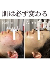 ハーブピーリング&毛穴洗浄専門店 肌REVO 高田馬場店[ニキビ/毛穴/たるみ/美白/シミ]/ニキビケアハーブピーリング