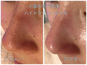 ソワン ド ブランシュ ライフ八戸ノ里店(Soin de Blanche)/小鼻の毛穴洗浄　ハイドラ美顔