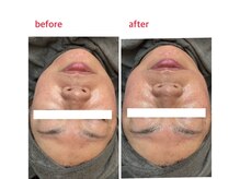 サロンドティアラ(Salon de Tiara)/メソポレーション3回目