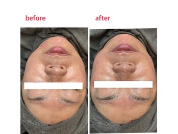 サロンドティアラ(Salon de Tiara)/メソポレーション3回目