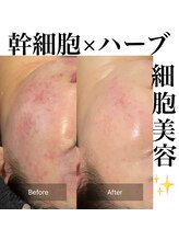 サロンツキ(salon tuki)/ハーブピーリング症例/徳島