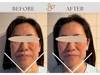 チョコバリ 渋谷店(chocobari)/小顔×リフトアップ(美容鍼)40代