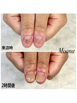 モアナ 池袋(MOANA)/人工爪深爪