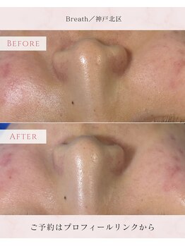 ブレス(Breath)/【韓国肌管理】セラピール