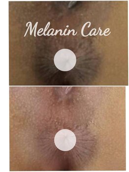 ペキュリア 恵比寿店(PEQLIA)/最新の黒ずみケア症例