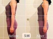 ロシュニ/40代 お悩み:たるみ/肋骨の厚み