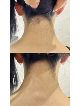 ワイズサロン(Y's salon)/うなじ脱毛