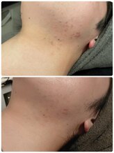 ルース(LUZ)/ニキビケア・思春期ニキビケア