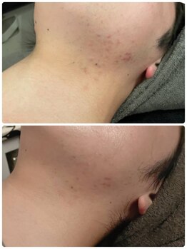 ルース(LUZ)/ニキビケア・思春期ニキビケア