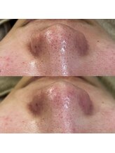 スイ 四条烏丸(SUI)/〇毛穴洗浄