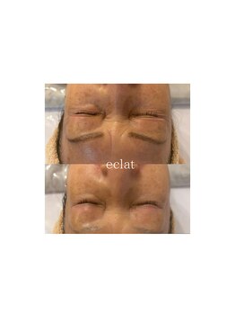 エクラ 五反田(eclat)/リアボーテ肌質改善
