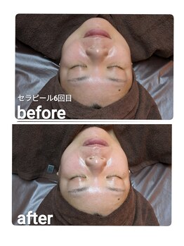 ウララ(ulala)/セラピール