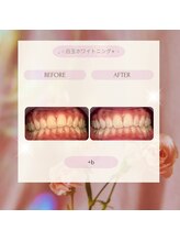 プラスビー 2号店(+b)/ホワイトニングビフォーアフター
