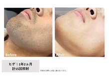 ザ エッセンシャル 碧南(THE Essential)/メンズ　ヒゲ脱毛