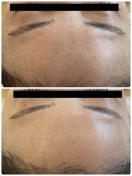 エイシスグロウ(asis glow.)/ララピール×水玉リフティング