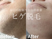 メイプル(Maple)/髭脱毛が2500円！お得すぎる！