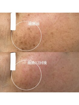 サロンドベルム(Salon de BELME)/シミケア経過：施術12回後