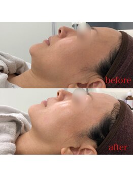 シーラックス(Sealax)/小顔フェイシャルには５DVリフト