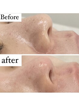 カルディエ(Cardie)/肌質改善　ビフォーアフター