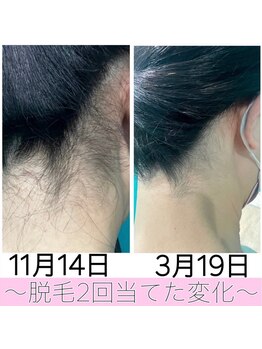 ヴィヴ 熊本(ViV)/【うなじWax】※脱毛機を併用