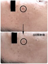 アロマアンドフェイシャルサロン &nbsp;エメシェリー(aimercherie)/フェイシャルメニュー☆シミケア