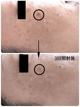 アロマアンドフェイシャルサロン &nbsp;エメシェリー(aimercherie)/フェイシャルメニュー☆シミケア