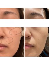 マーギアー(Magier)/ハーブ＋ダーマ　初来店→７回目