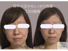 小顔職人/ 小顔ビフォーアフター/30代