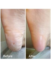 リゼラアンドコー 鹿沼店/角質ケア