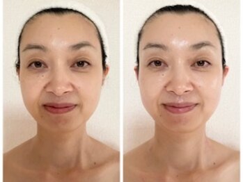 ル シエル(Le Ciel)/40代/施術正面/左before右after