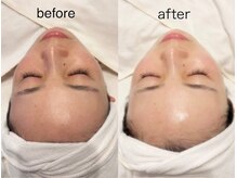 エステサロン ロティオン/落ちないファンデメソスキン