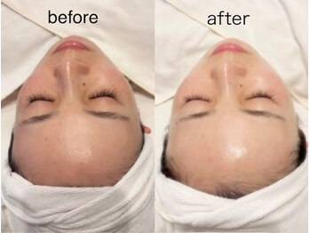 エステサロン ロティオン/落ちないファンデメソスキン